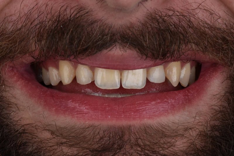Antes